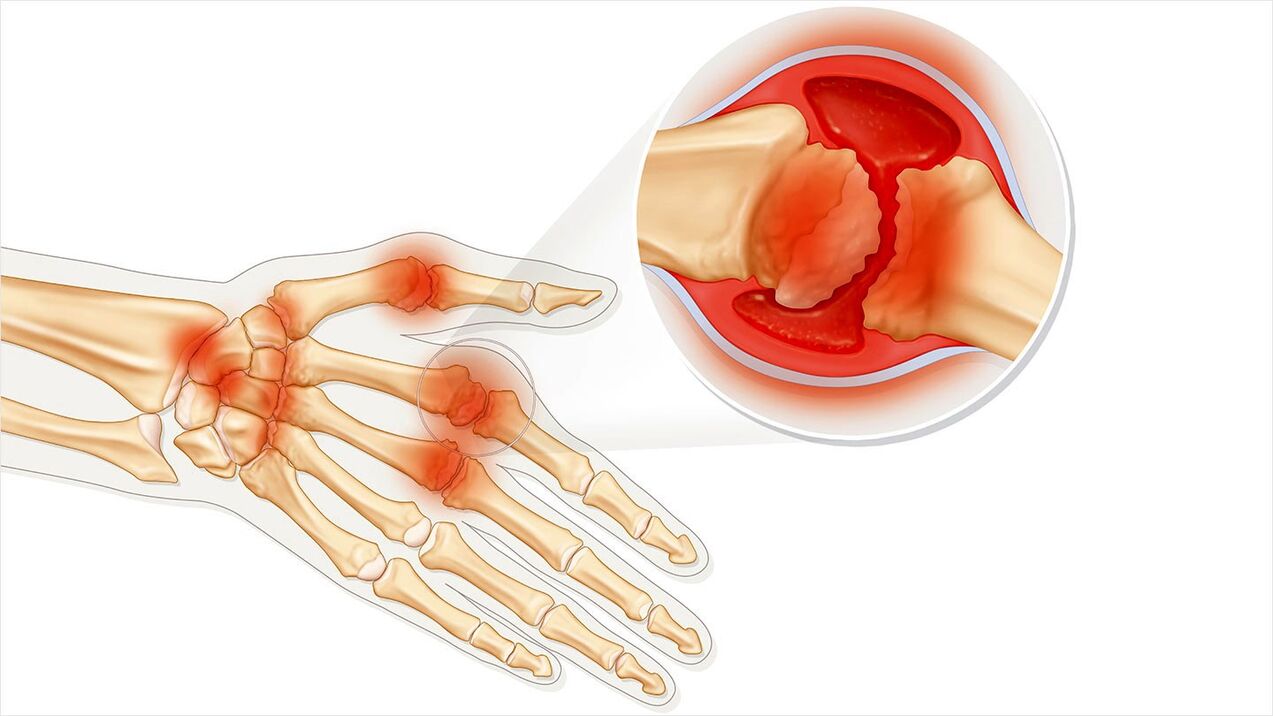 Osteoarthritis to be treated with Traugel