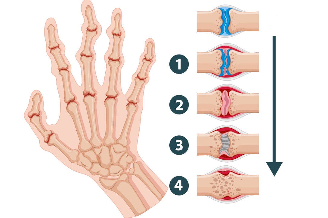 Developmental stages of arthritis – inflammatory joint damage