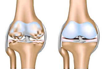 Healthy joints and osteoarthritis