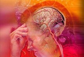 Neck migraine syndrome