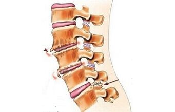 Spondylarthrosis as the causes of back pain
