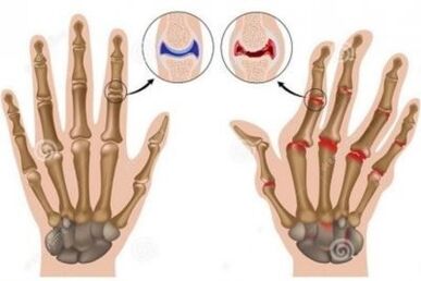 The causes of pain in the fingers joints