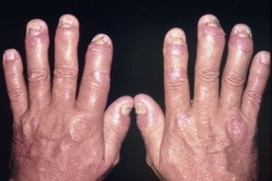 Why hurt the joints of the fingers