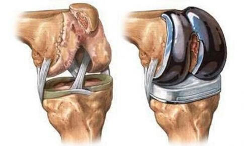 Endoprosthetics of the knee joint for arthrosis