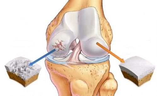Healthy joint and osteoarthritis of the knee joint