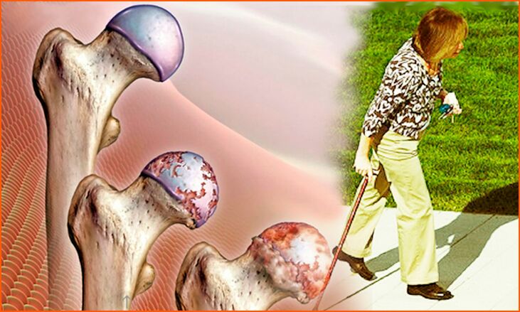 Persistent lameness in the final stage of arthrosis of the hip joint