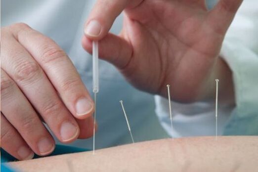 Acupuncture is a method of treating lumbar pain caused by osteochondrosis