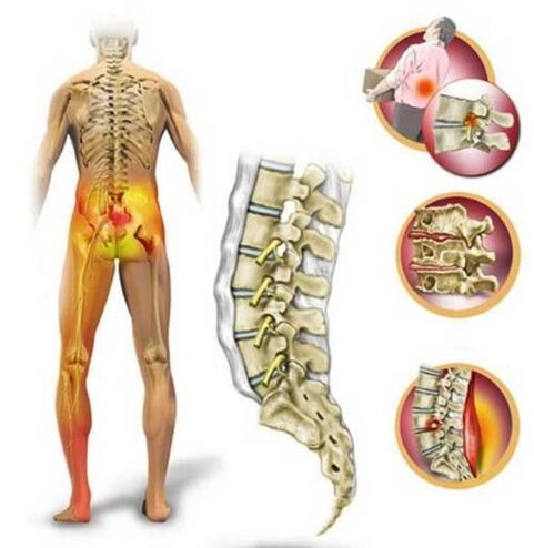 Osteochondrosis of the lumbar spine, causing pain in the lower back