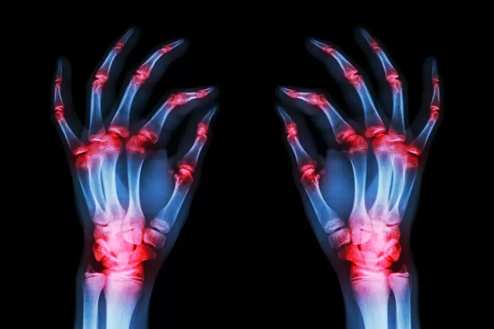 Osteoarthritis of the finger joints