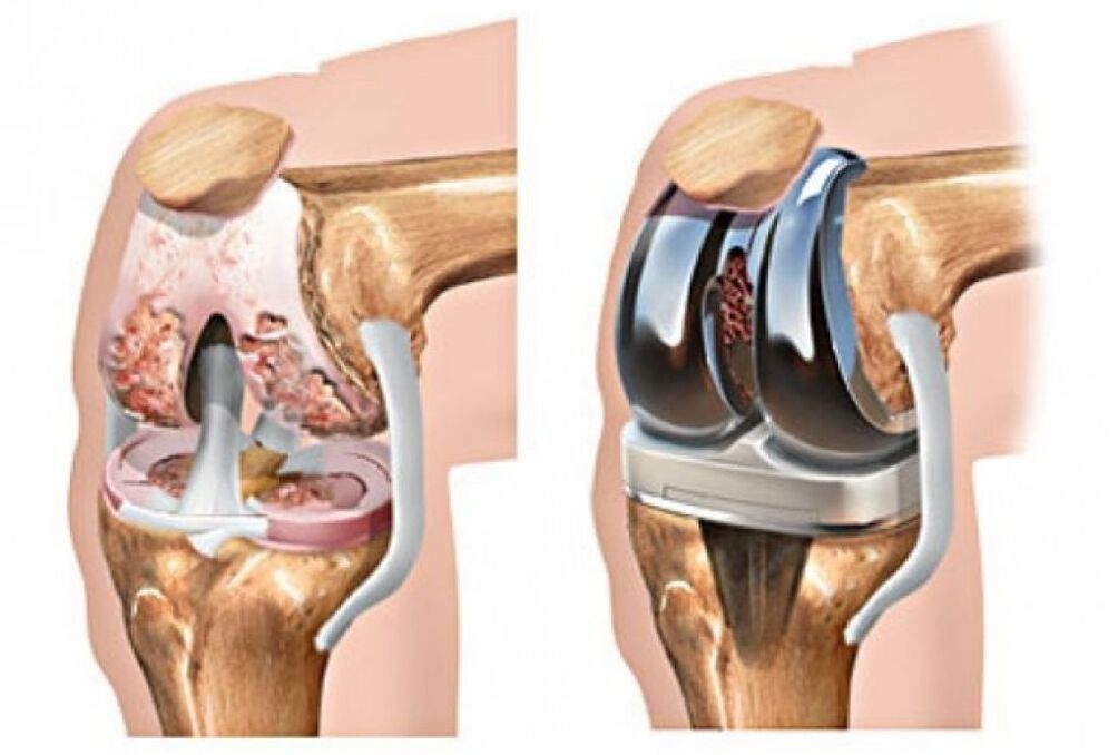 Knee arthroplasty in osteoarthritis